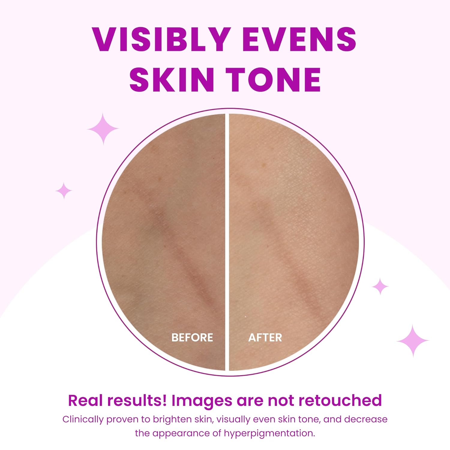 Lume Acidified Body Cream - Smooth Appearance of Rough. Bumpy Skin